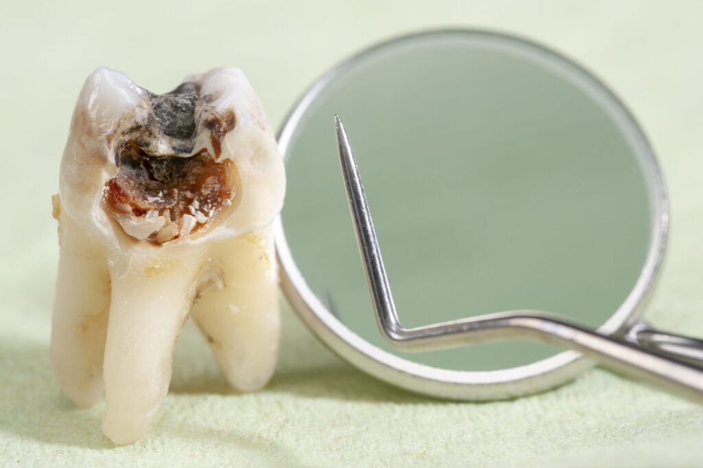 como-eliminar-caries-scaled